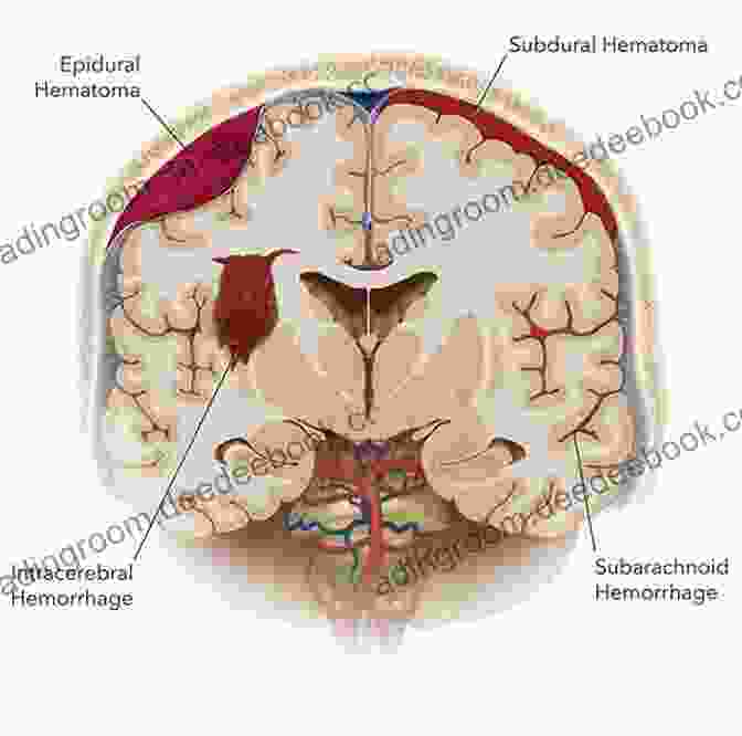 A Diagram Of The Brain Showing A Subarachnoid Hemorrhage Management Of Subarachnoid Hemorrhage John D Rothschild